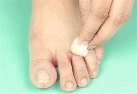 ayak parmak arası mantar doğal tedavi